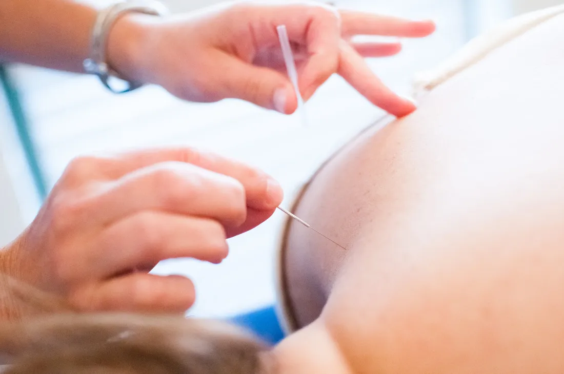 Dry needling treatment at PhysioSport